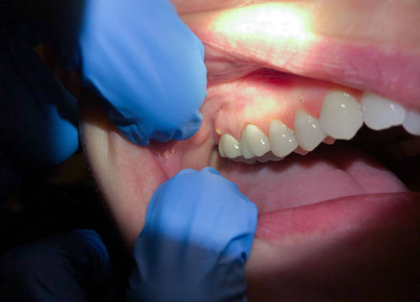 Best Emergency Dentist for Lost Fillings or Crowns in Eastlake, OH